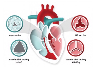 Bệnh van tim: Giải đáp tất cả các câu hỏi thường gặp